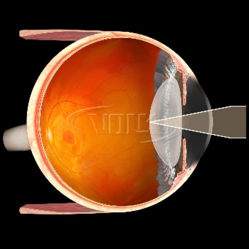 Volk Capsulotomy Lens View