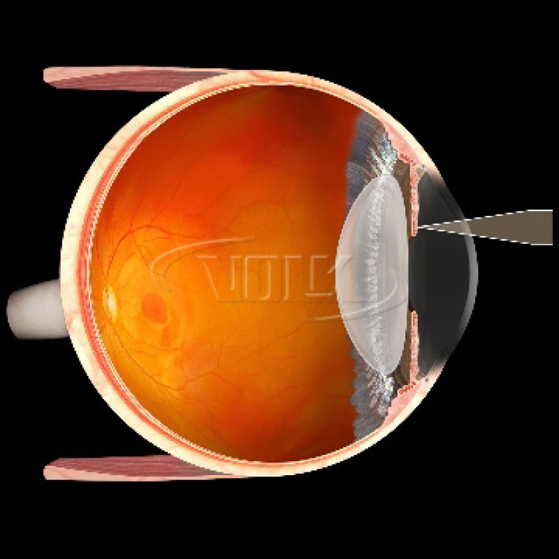 Volk Mag Plus Iridectomy Lens